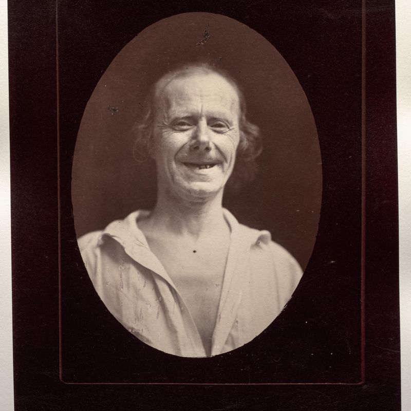 Figure 32: Natural laughter by the voluntary contraction of the two large zygomatics and the lower palpebral orbicularis
