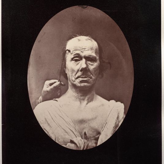 Figure 7: Étude du méchanisme et de l'expression du muscle frontal chez un vieillard: à droit, attention; à gauche, repos