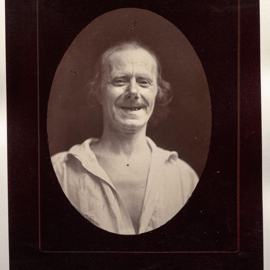 Figure 32: Natural laughter by the voluntary contraction of the two large zygomatics and the lower palpebral orbicularis